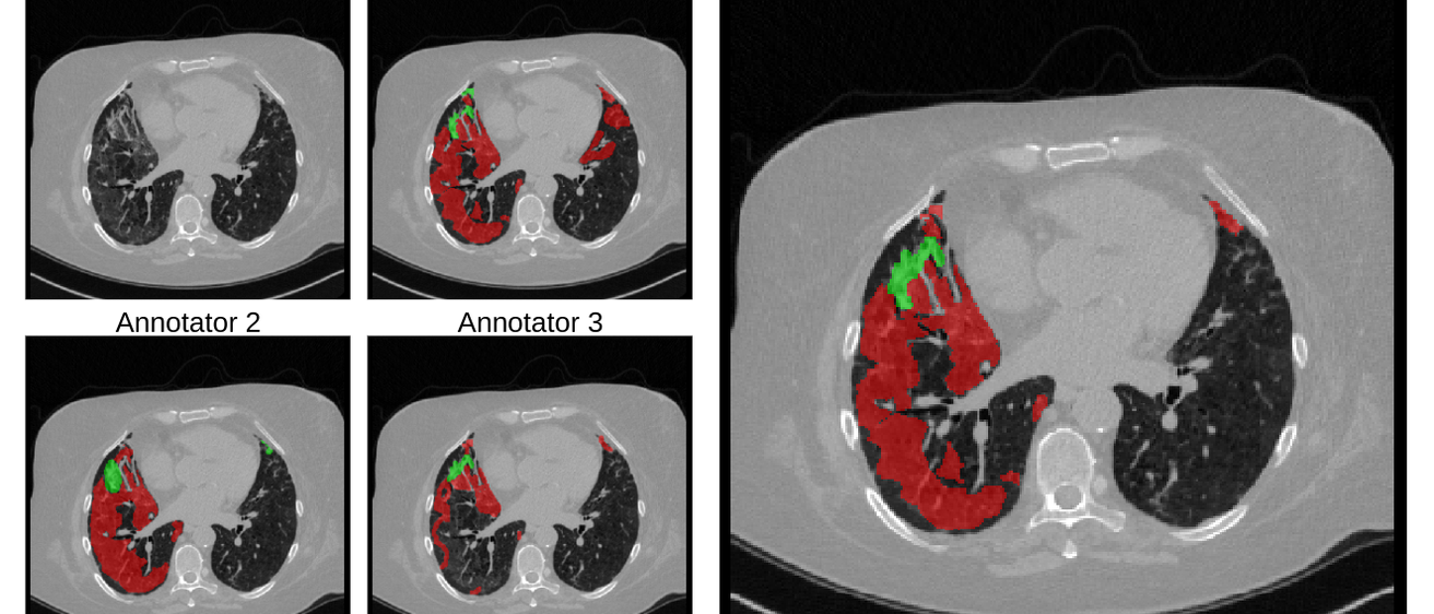 Cross-sectional CT images with annotated regions of abnormalities