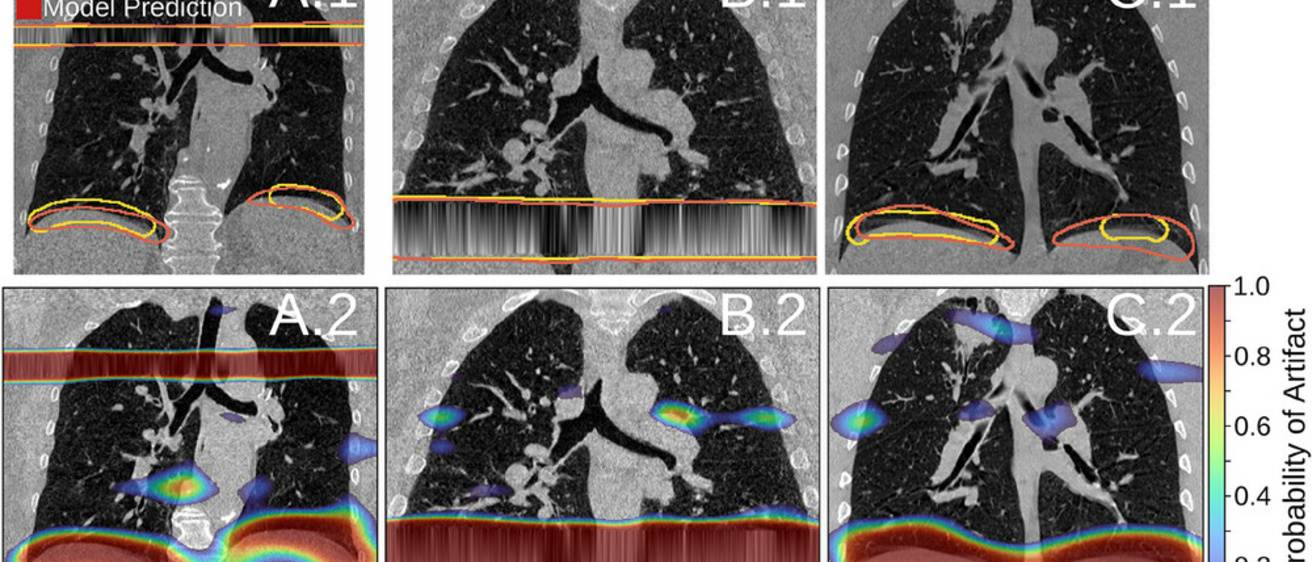 Figure showing a CT image with artifacts and artifacts detected by a deep learning approach