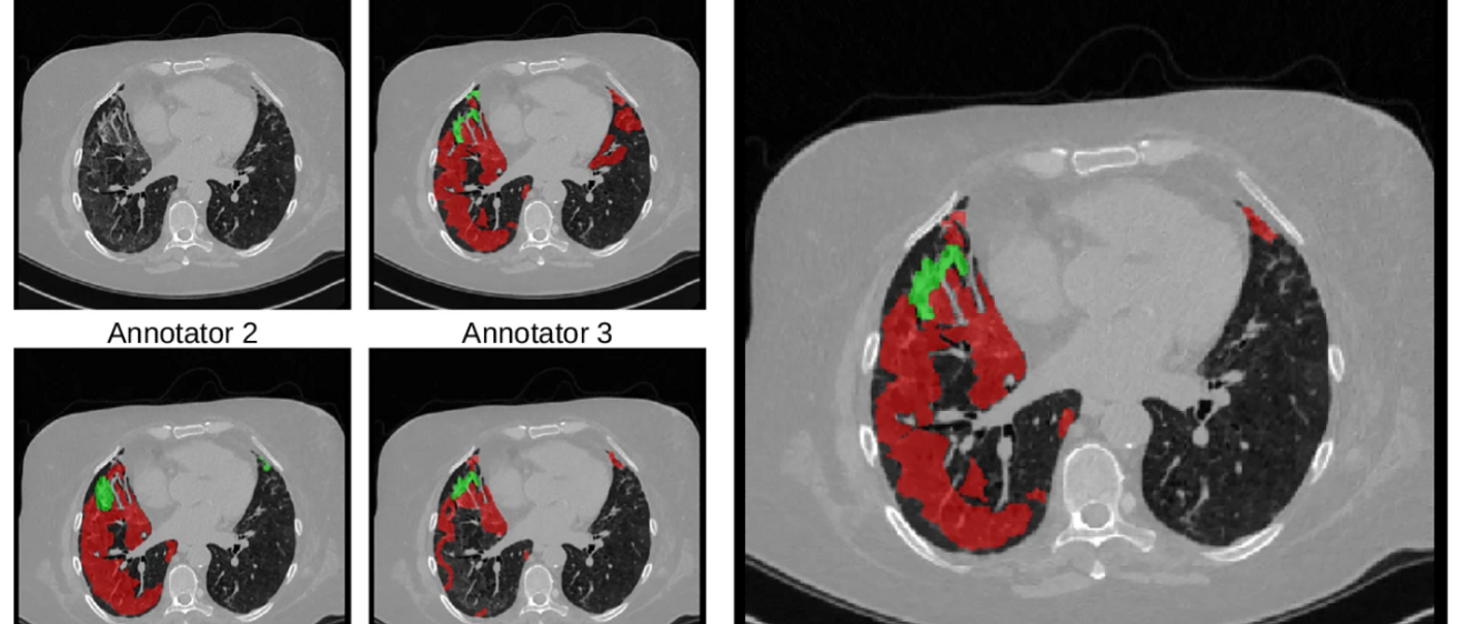 lung CT image showing manual annotations of COVID lesions