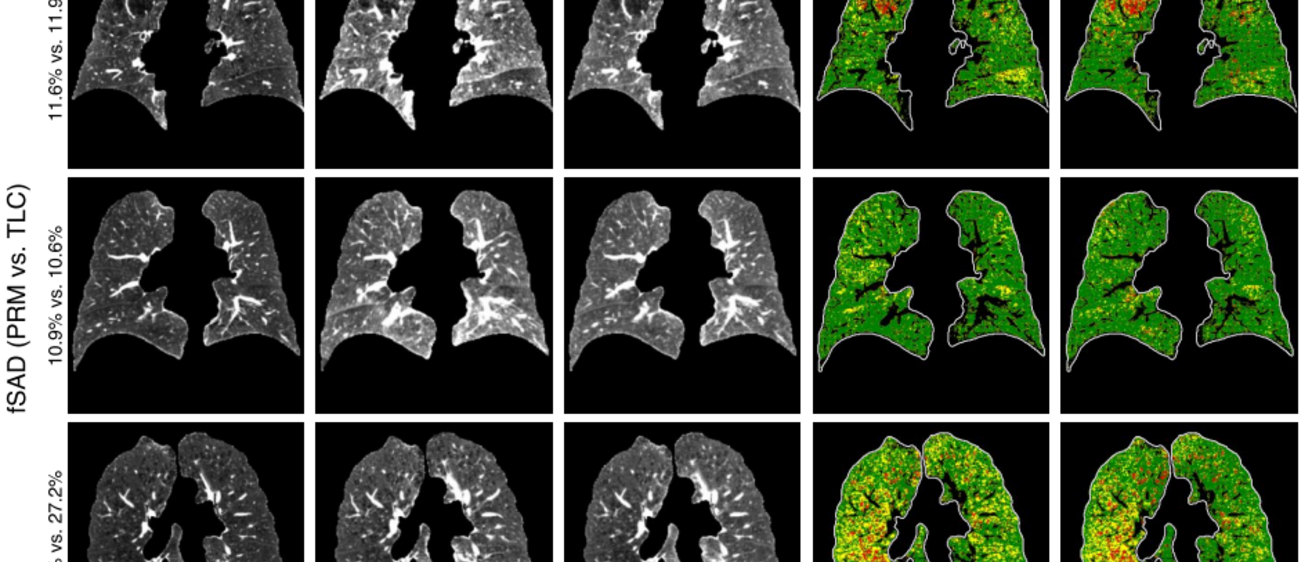Lung CT images showing real and synthetic scans and estimates of PRM overlays