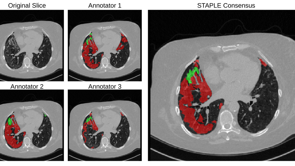 Cross-sectional CT images with annotated regions of abnormalities