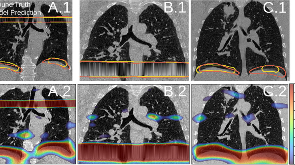 Figure showing a CT image with artifacts and artifacts detected by a deep learning approach