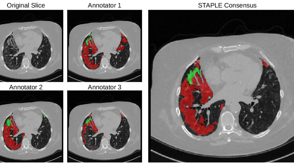 lung CT image showing manual annotations of COVID lesions