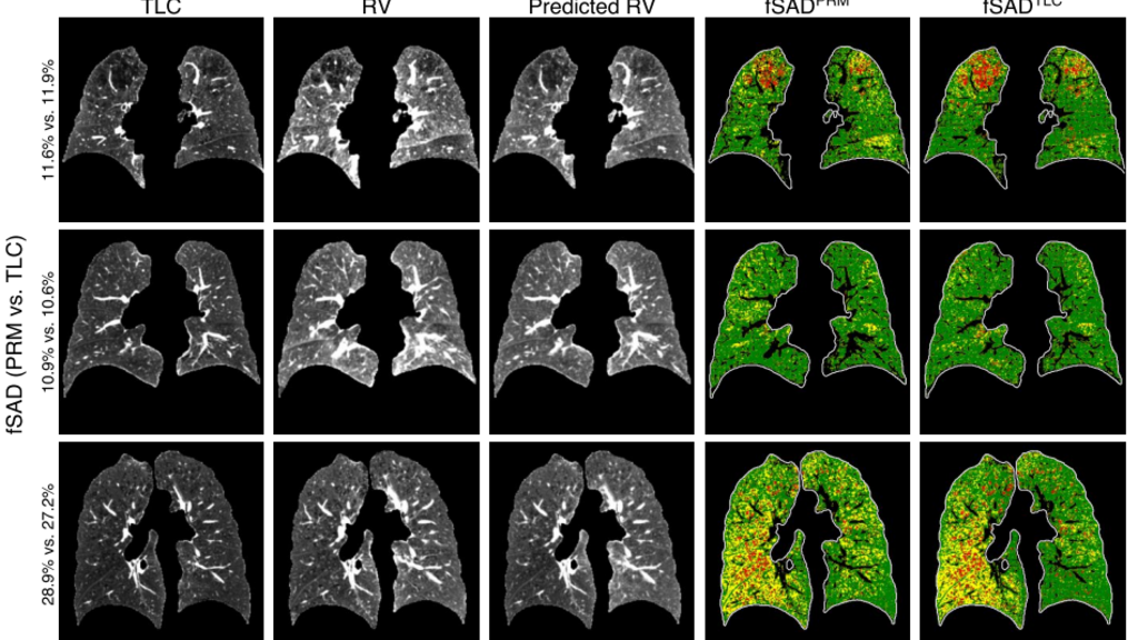 Lung CT images showing real and synthetic scans and estimates of PRM overlays